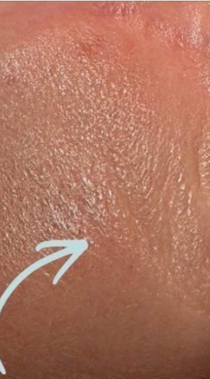 After close-up of smoother-looking cheek texture after Jet Plasma care