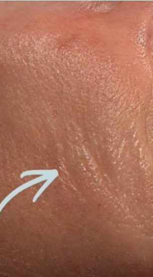 Before close-up of cheek texture before Jet Plasma care