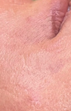 After lower face profile after Jet Plasma care