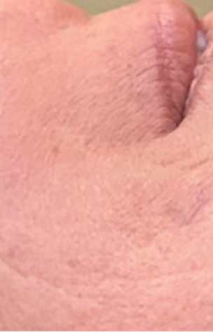 Before lower face profile before Jet Plasma care